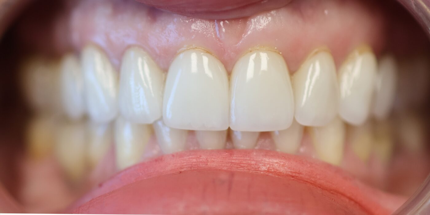 Before porcelain veneers